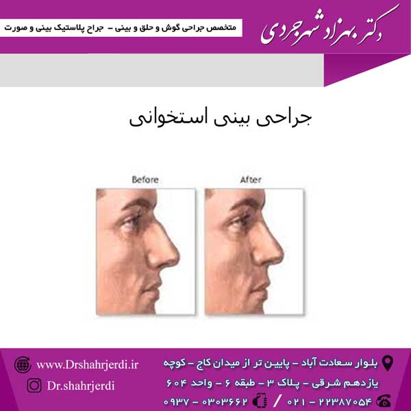 جراحی بینی استخوانی