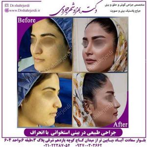 جراحی بینی استخوانی