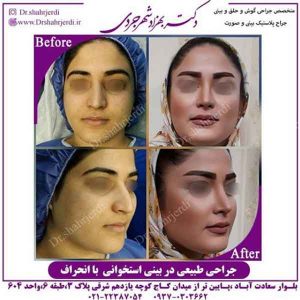 جراحی بینی استخوانی