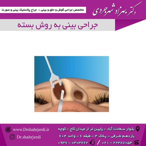 جراحی بینی به روش بسته