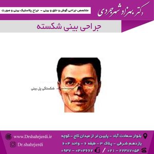 جراحی بینی شکسته