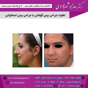 تفاوت جراحی بینی گوشتی با جراحی بینی استخوانی
