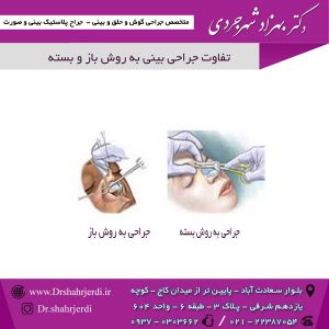 تفاوت جراحی بینی به روش باز و بسته