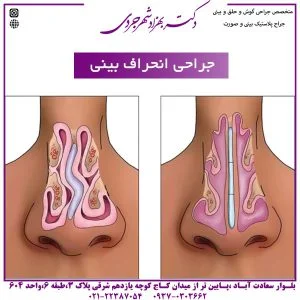جراحی انحراف بینی