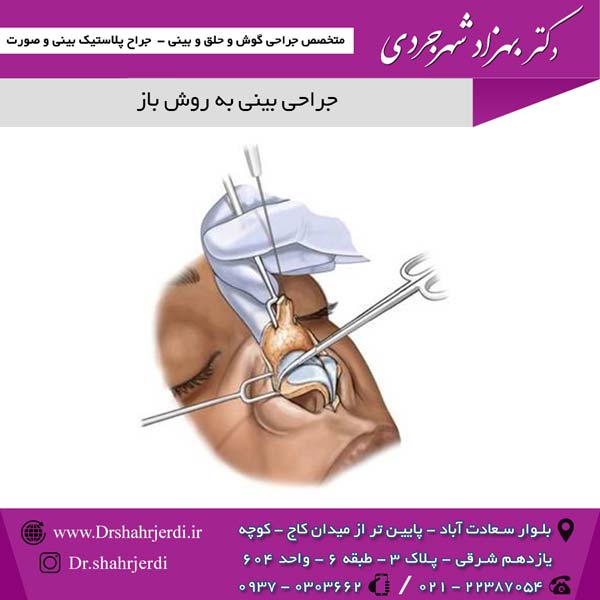 جراحی بینی به روش باز