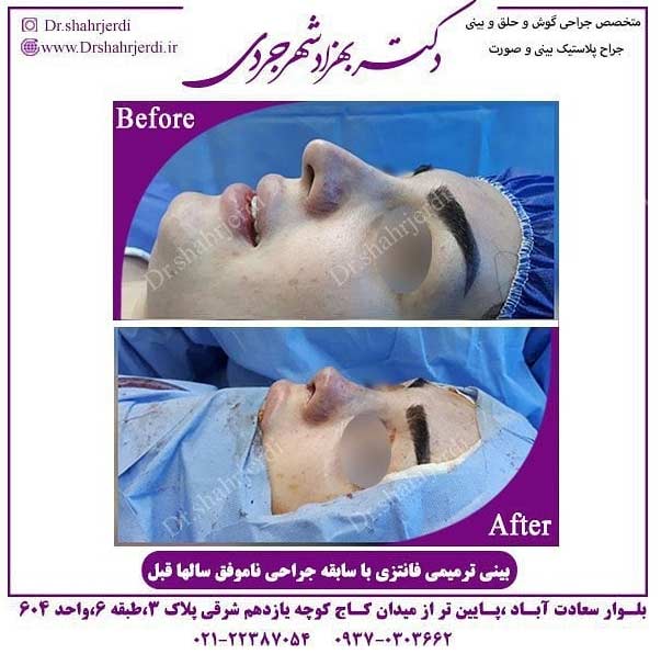 جراحی بینی ترمیمی در تهران - دکتر شهرجردی