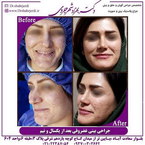 مراحل جراحی بینی