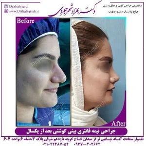 تفاوت جراحی بینی طبیعی و فانتزی