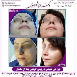تفاوت جراحی بینی طبیعی و فانتزی