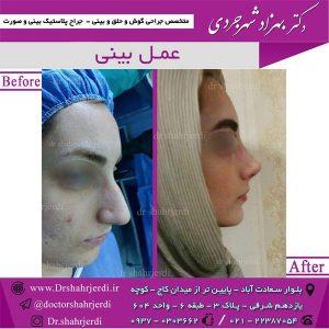 بعد از عمل بینی 