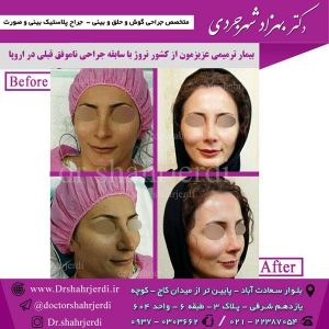 ترمیم بینی عمل شده 