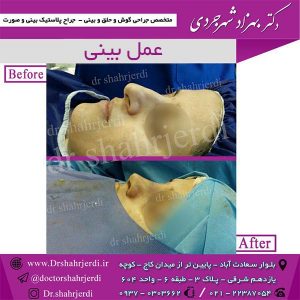عمل بینی