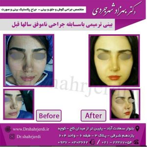 عمل بینی ترمیمی