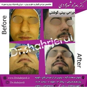 عمل بینی گوشتی