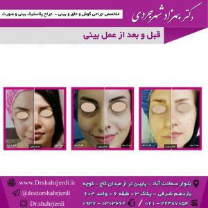قبل و بعد از عمل بینی 