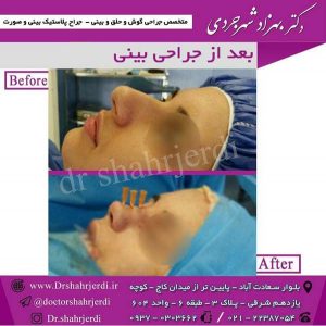 بعد از جراحی بینی 