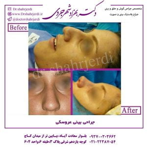 جراحی بینی عروسکی