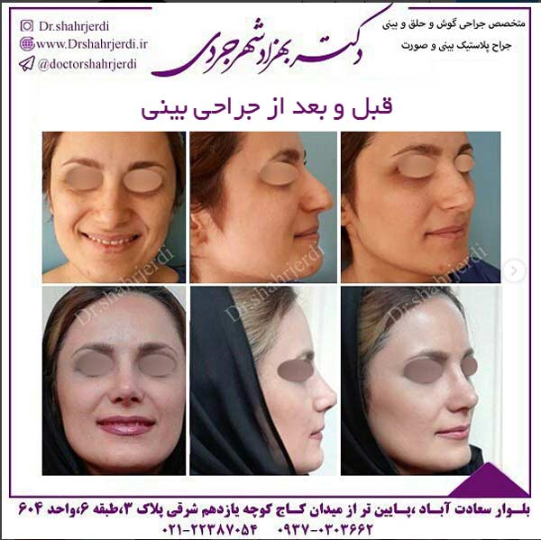 قبل و بعد از جراحی بینی