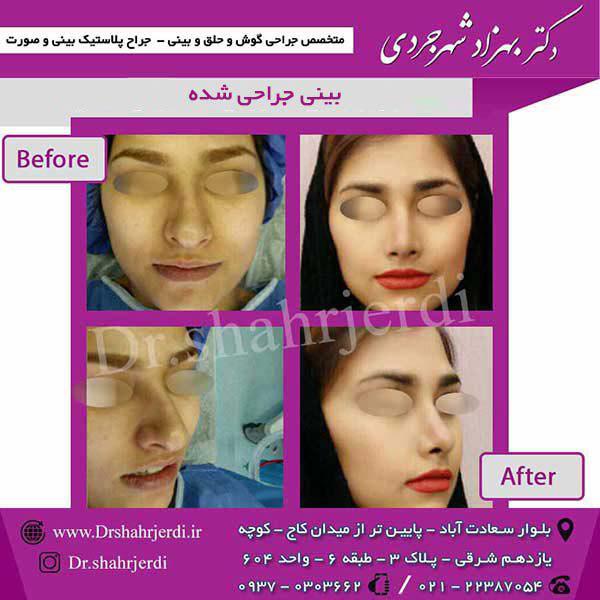 بینی جراحی شده