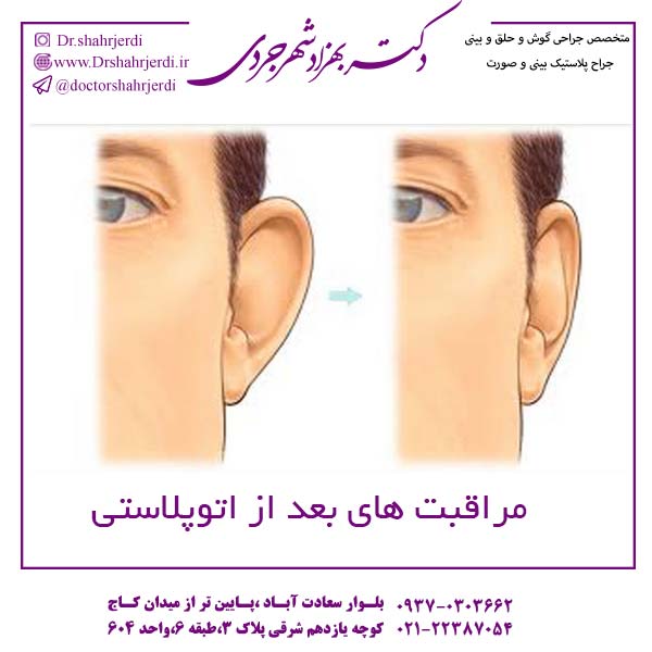 مراقب های بعداز اتوپلاستی