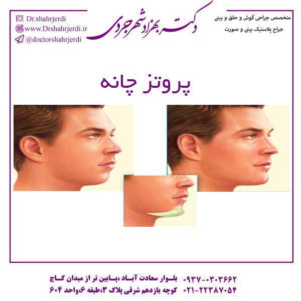 پروتز چانه