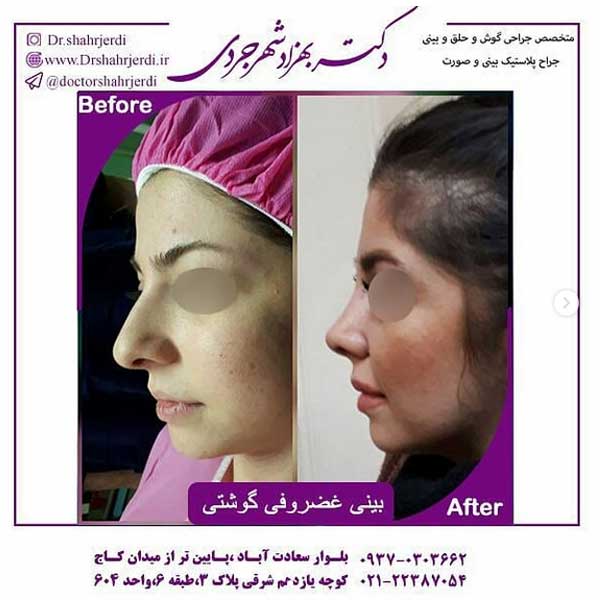 بینی استخوانی با پوست ضخیم