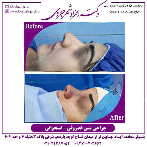 جراحی بینی مدرن