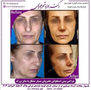 جراحی بینی استخوانی
