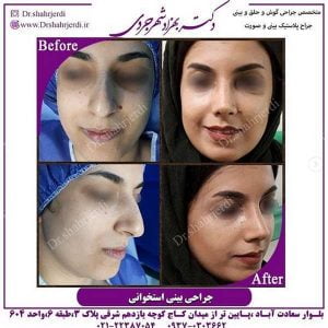 جراحی بینی استخوانی