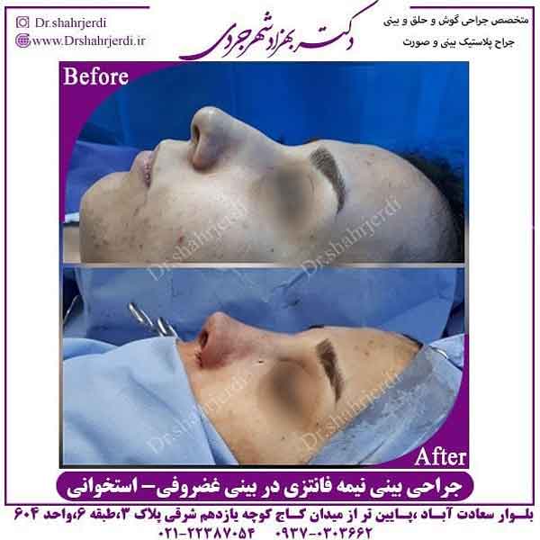 جراحی بینی در زنان