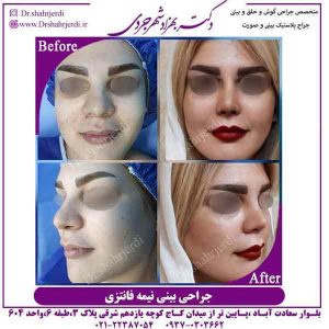 جراحی زیبایی بینی در تهران
