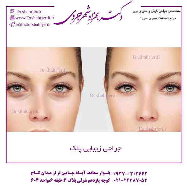 جراحی زیبایی پلک در تهران