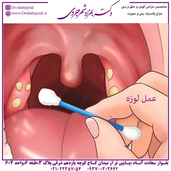 عمل لوزه در تهران 