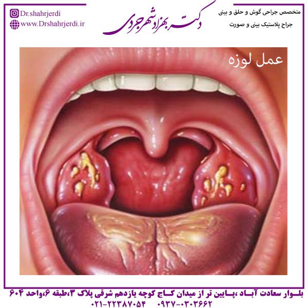 عمل لوزه - دکتر شهرجردی