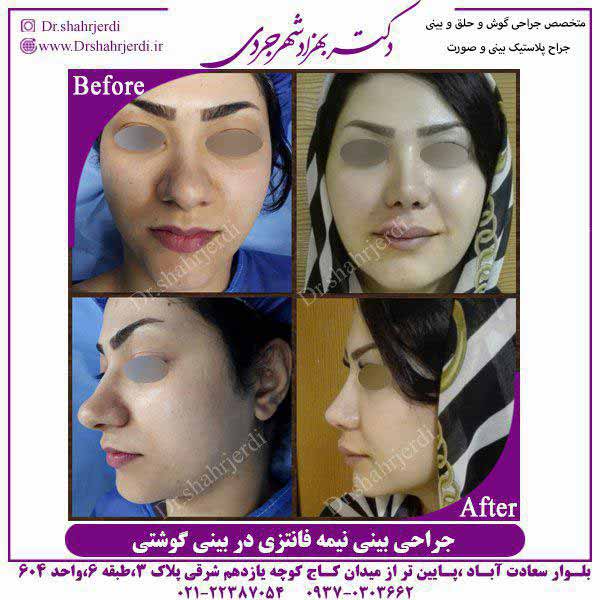 کوچک کردن بینی