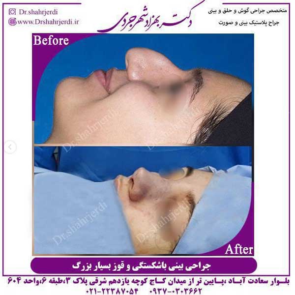 بهترین دکتر عمل بینی در تهران