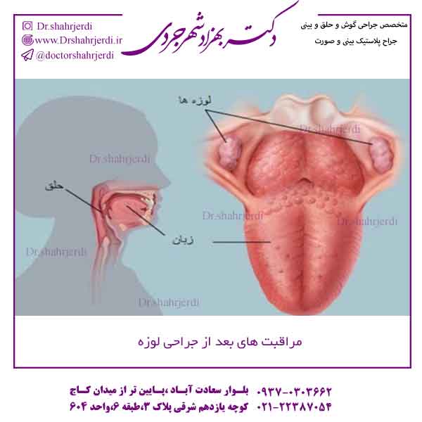 مراقبت های بعد از عمل لوزه