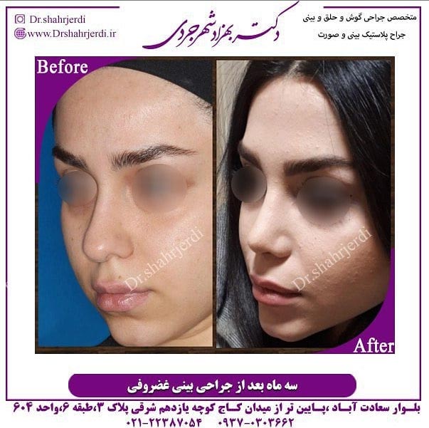عمل جراحی زیبایی بینی