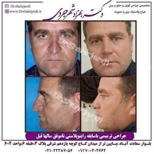 دکتر ترمیمی بینی خوب در تهران