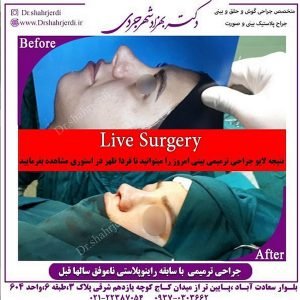 دکتر ترمیمی بینی خوب در تهران