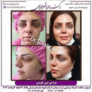 جراحی بینی استخوانی