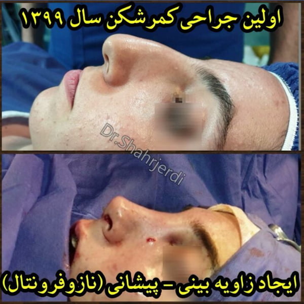 جراحی بینی طبیعی