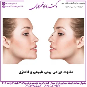 تفاوت جراحی بینی طبیعی و فانتزی