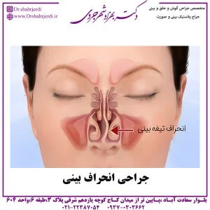 جراحی انحراف بینی