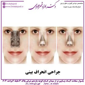 جراحی انحراف بینی