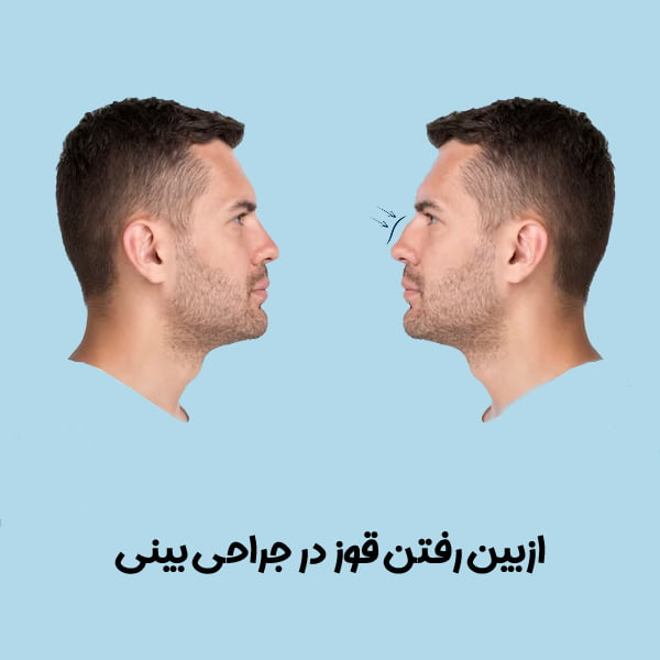 جراحی بینی در تهران - دکتر شهرجردی