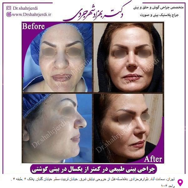 غکس قبل و بعد جراحی بینی طبیعی
