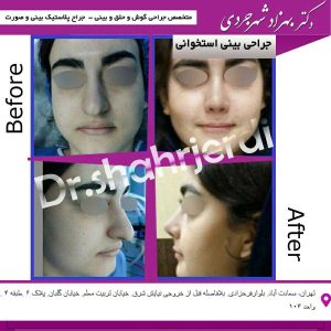 جراحی بینی طبیعی - دکتر بهزاد شهرجردی