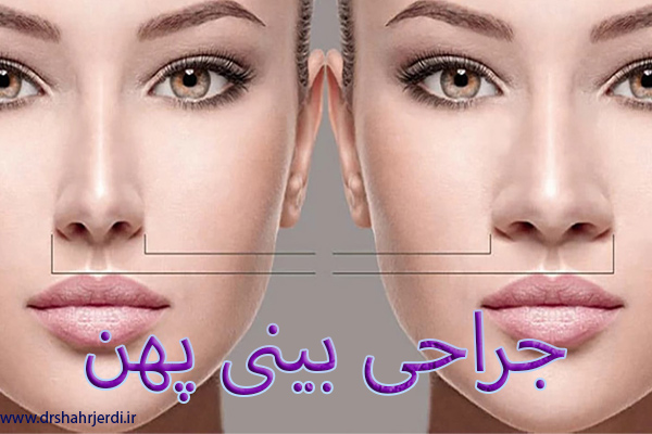 جراحی بینی پهن - دکتر بهزاد شهرجردی