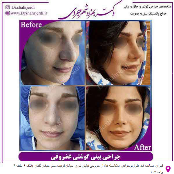 جراحی بینی گوشتی - دکتر مجتبی سهراب پور
